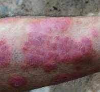 治疗牛皮癣经常遇到的三大误区有哪些